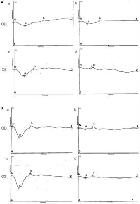 A novel mutation in RS1 and clinical manifestations in a Chinese twin family with congenital <mark class="highlighted">retinoschisis</mark>